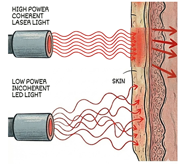 Laser Versus LED Light