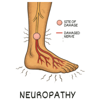 Exercise and Neuropathy